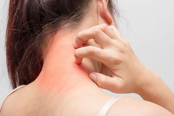 Tres tratamientos caseros que calman la alergia en la piel