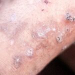 Haití alerta sobre una rara y muy contagiosa enfermedad de la piel