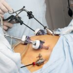  Cirugía bariátrica para la obesidad a partir de los 65 años: una victoria cardiovascular