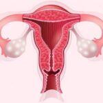 Cáncer de Ovarios: Asesino silencioso que aumenta el riesgo de padecerlo a partir de los 50 años